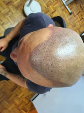 Slider image (3) SMP Advanced - Scalp Micro Pigmentation